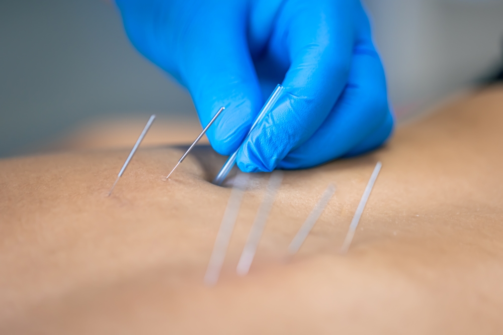 Dry needling service being performed on a patient's back